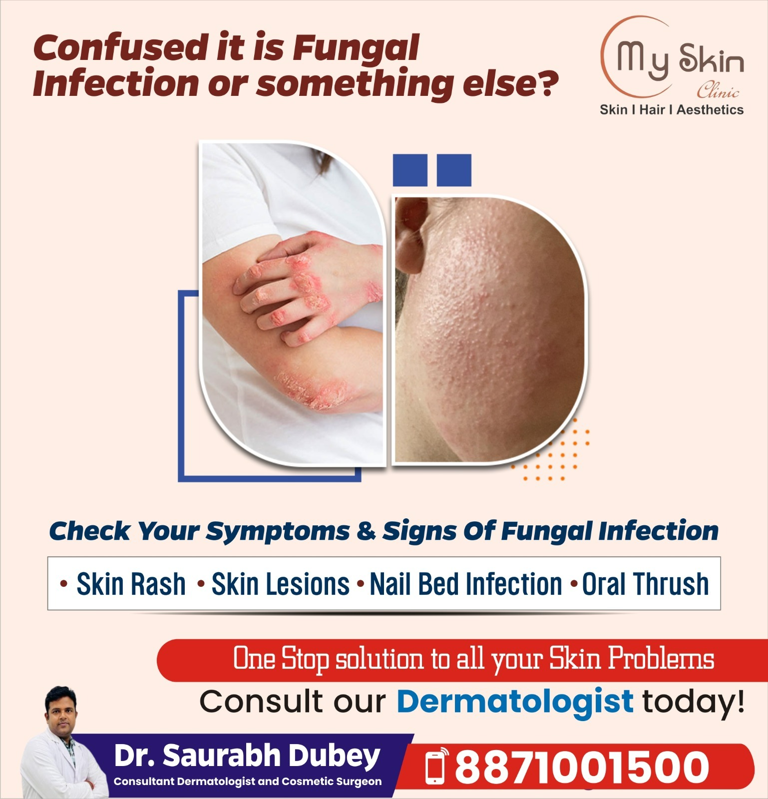 Skin Rash & Fungal Infection Care in Indore
